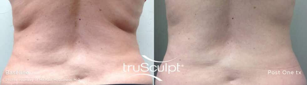 Body Contouring With Trusculpt Id Premier Ob Gyn And Med Spa Aesthetics