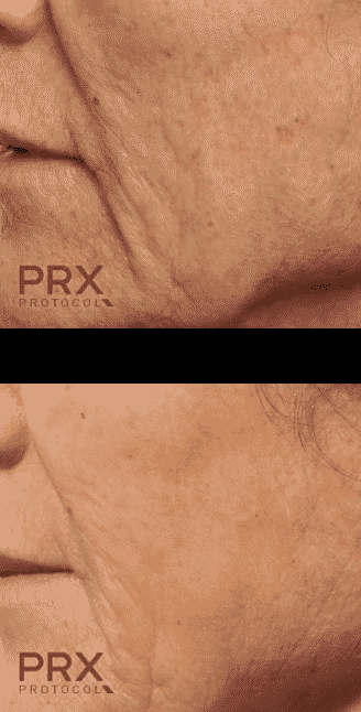juliet laser facial resurfacing results