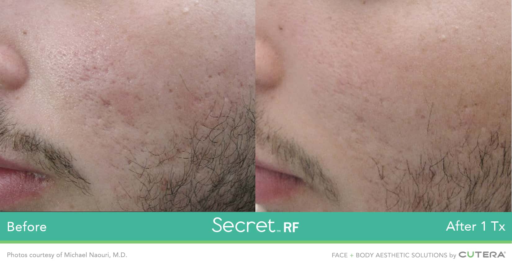 Secret-RF-Before-and-After-male-acne