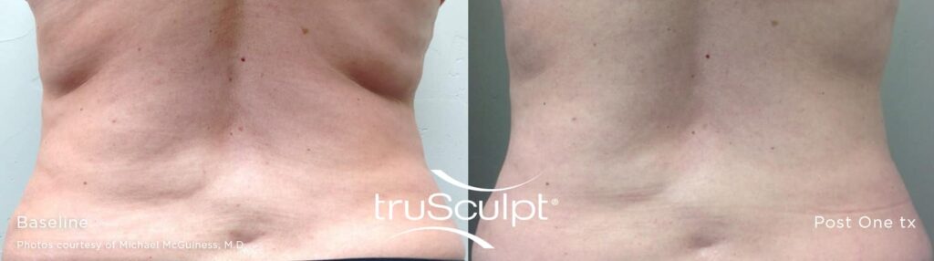 TruSculpt-before-and-after-back-fat
