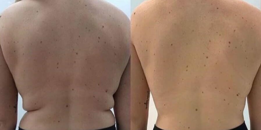 TruSculpt-before-and-after-love-handles-e1571140525254