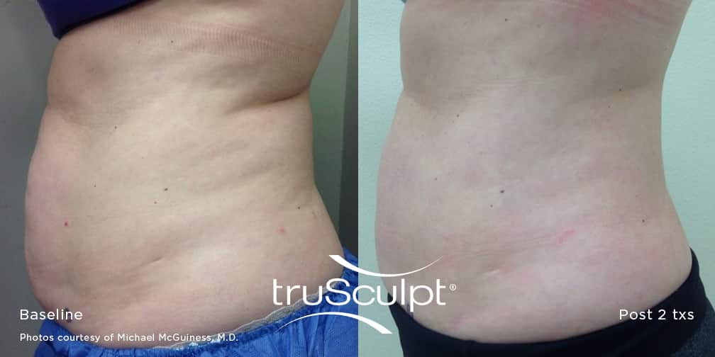 Trusculpt-before-and-after-stomach