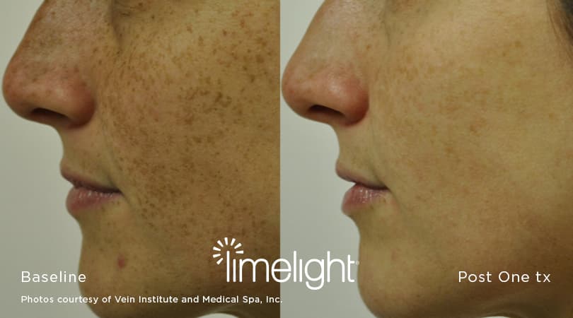 limelight-ipl-image