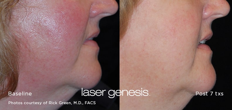xeo_LaserGenesis_3